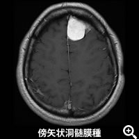 傍矢状洞髄膜種