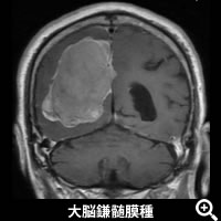 大脳鎌髄膜種