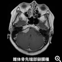 錐体骨先端部髄膜種