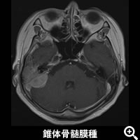 錐体骨髄膜種