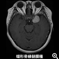 蝶形骨縁髄膜種