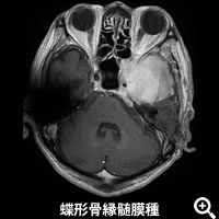 蝶形骨縁髄膜種