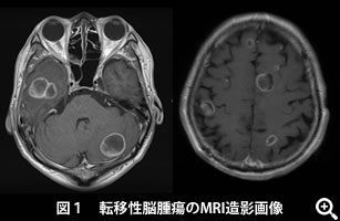 図１　転移性脳腫瘍のMRI造影画像