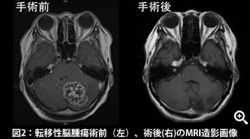 図2：転移性脳腫瘍術前（左）、術後(右)のMRI造影画像