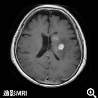 造影MRI