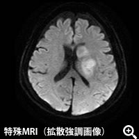 特殊MRI（拡散強調画像）