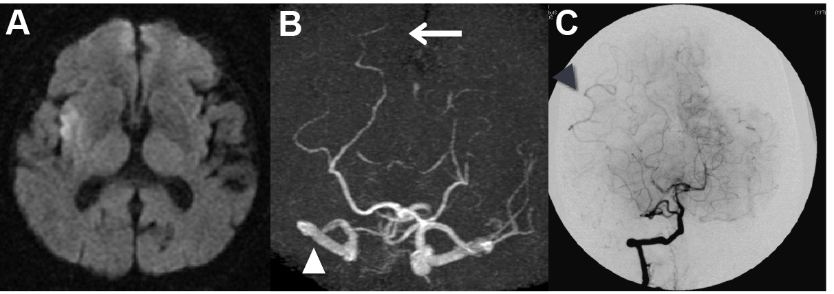 Diffusion weighted imaging of MRI (A), MR angiography (B), and Digital subtraction angiography (C) of the patients with right proximal middle cerebral artery occlusion are shown above. On MRA (B), in accordance with the right middle cerebral artery occlusion (arrow head), right posterior cerebral artery is prolonged (arrow) compared to the left side. This posterior cerebral artery laterality is matched with the collateral circulation through leptomeningeal arteries represented by angiography (C), and is predictive of smaller infarction volume and better long-term neurological outcome.