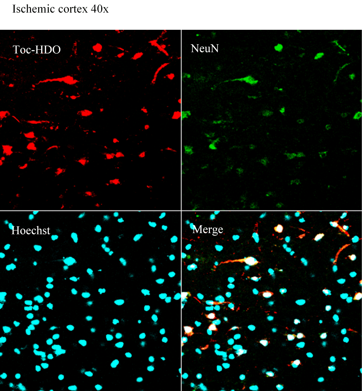 Fluorescence-labeled DNA/RNA heteroduplex oligonucleotide (HDO) intravenously administered to mouse model of ischemic stroke. HDO signals (red) are mainly seen in neurons (green).