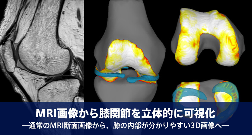 MRI画像から膝関節を立体的に可視化―通常のMRI断面画像から、膝の内部が分かりやすい3D画像へ―